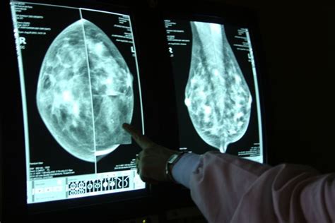 the villages screening mammogram